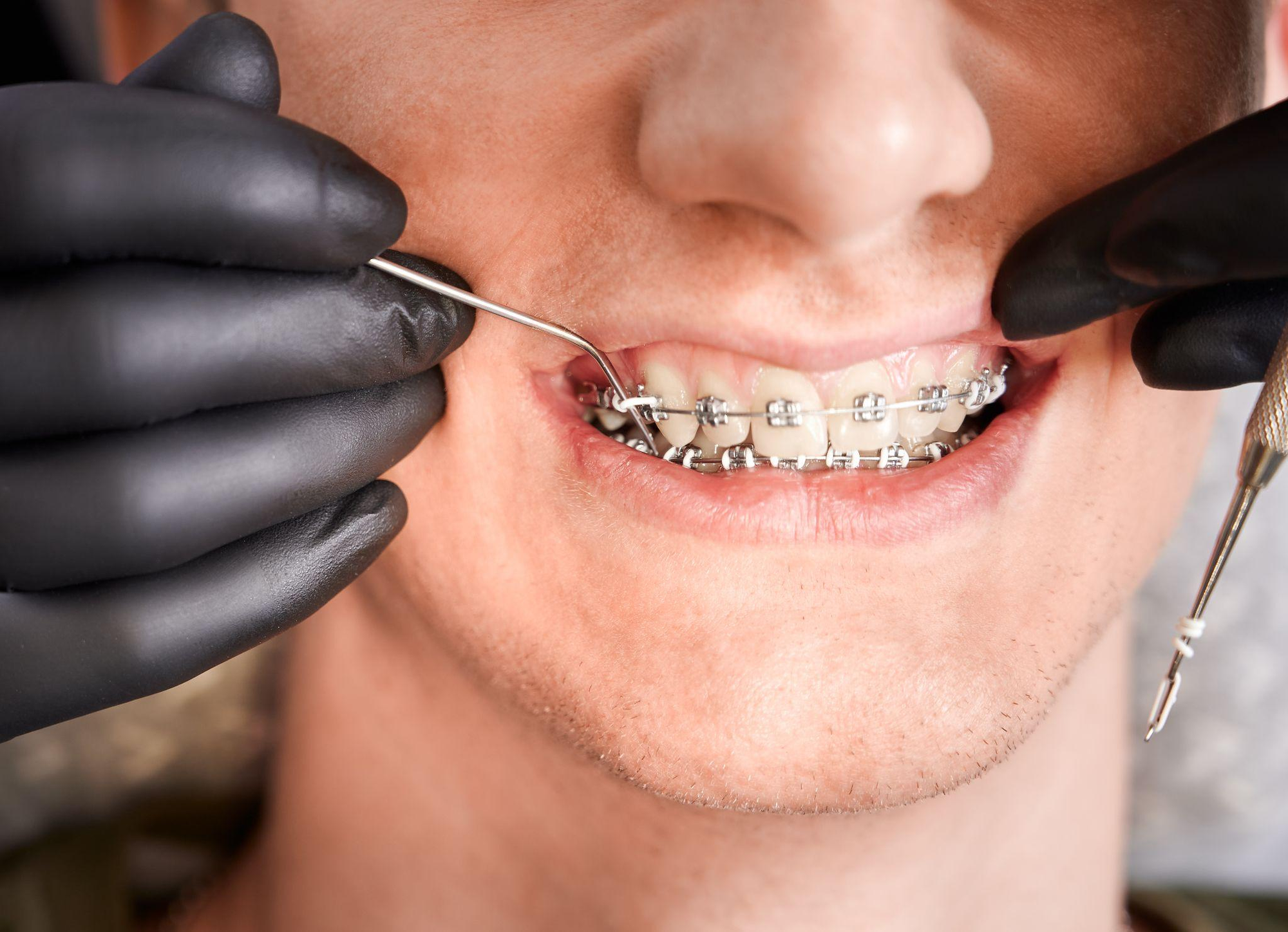 Braces Tightening: Why and How it's Done, and is it Painful?