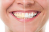 Teeth whitening at home | NewSmile Invisible Aligners