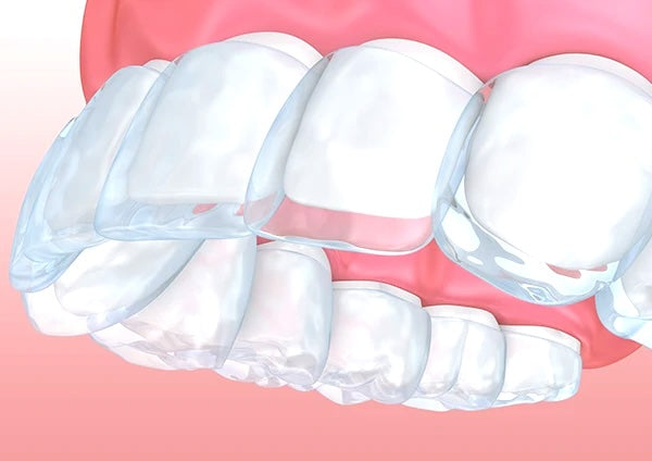 What If My Clear Aligners Are Not Moving My Teeth?